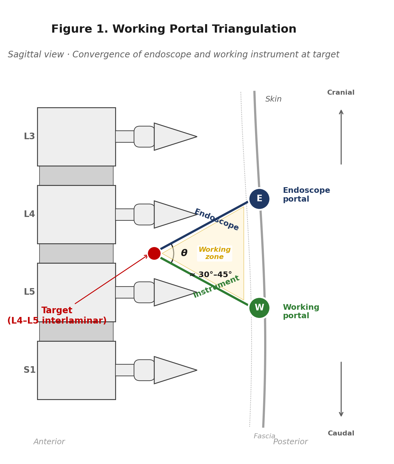 Sagittal view of UBE working portal triangulation showing endoscope and working instrument converging at the L4–L5 interlaminar target with a 30–45° angle.