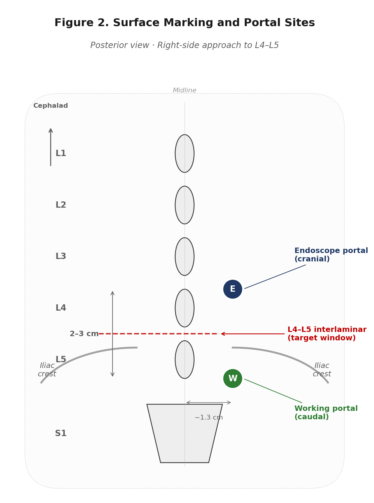 Posterior view surface marking for a right-side L4–L5 approach, showing endoscope portal cranial and working portal caudal to the target interlaminar window, approximately 1.3 cm lateral to midline.