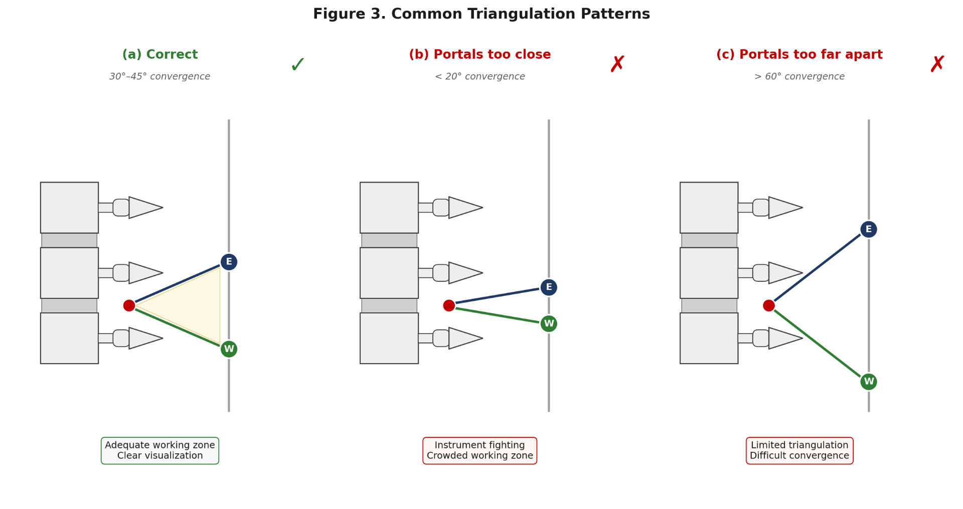 Three triangulation patterns: correct 30–45° convergence with adequate working zone; portals too close producing <20° convergence and instrument fighting; portals too far apart producing >60° convergence and limited triangulation.